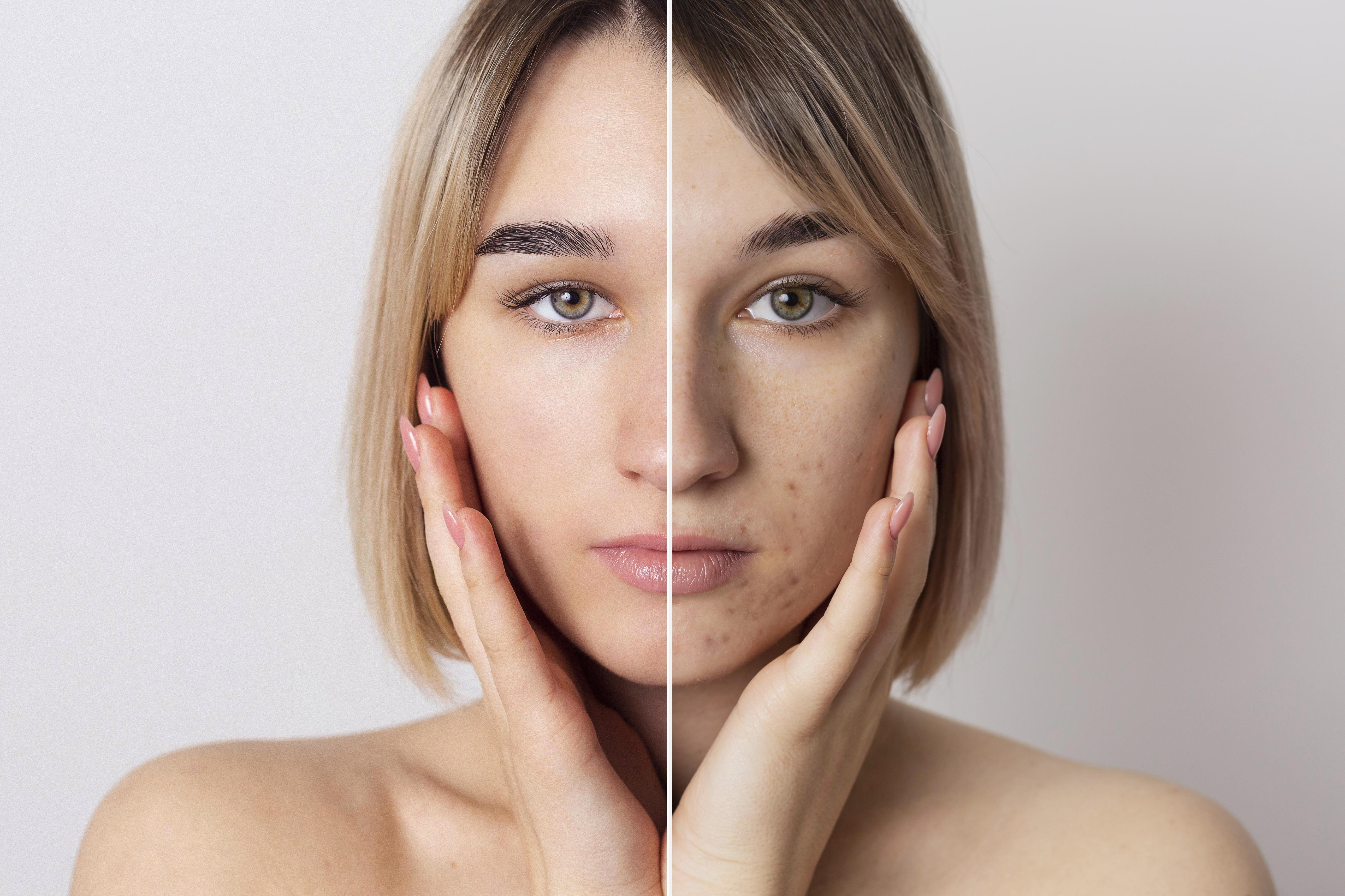 Dermapen